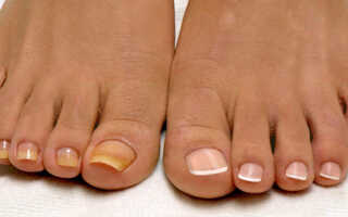 Эффективные способы лечения грибка ногтя на ноге
