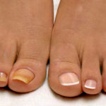 Эффективные способы лечения грибка ногтя на ноге