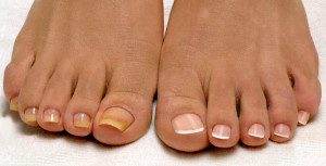 грибок ногтя на большом пальце ноги лечение в домашних условиях